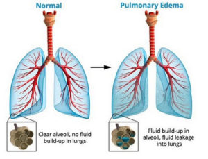 pulmonary edema treatment