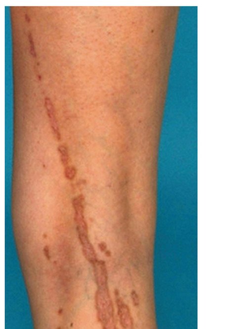 A patient demonstrating the symptoms of linear porokeratosis.photo