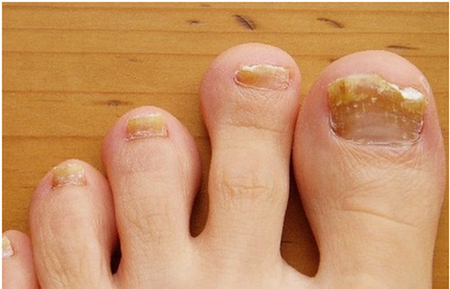 What Causes Brittle Thick Toenails