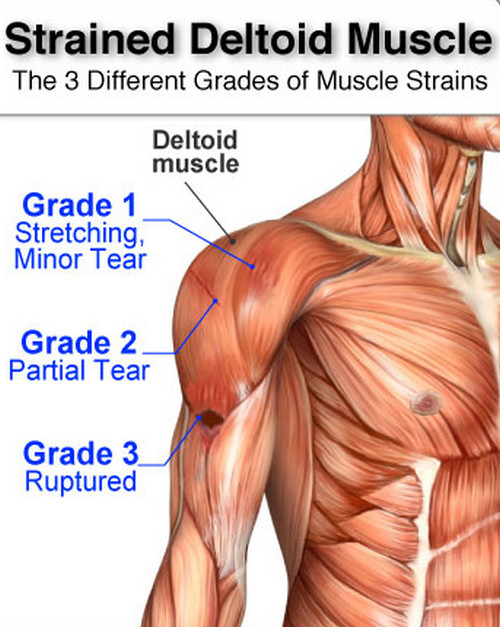 The three different grades of muscle strain picture