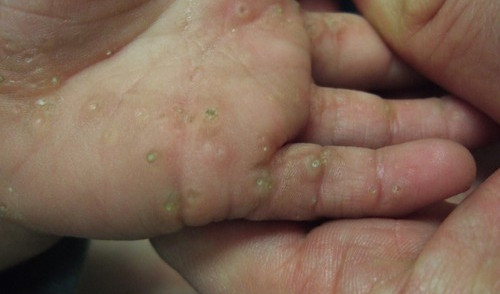 Typical signs and symptoms of punctate porokeratotic keratoderma.photo