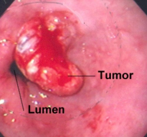 A tumor in the esophagus, which is one of the reasons for painful swallowing image