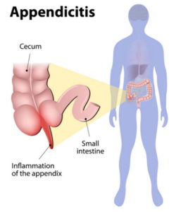 What side is your appendix on - (updated in 2022)