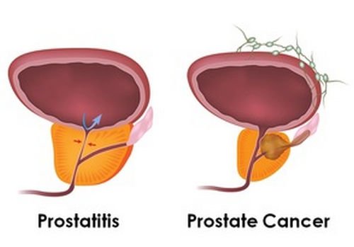 A comparison image between a normal-healthy prostate and prostate cancer image photo picture