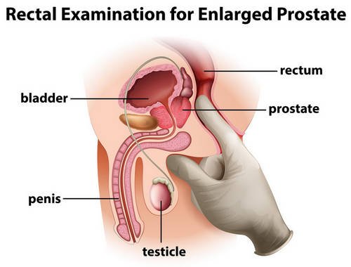 A rectal examination to detect an enlarged prostate photo image picture