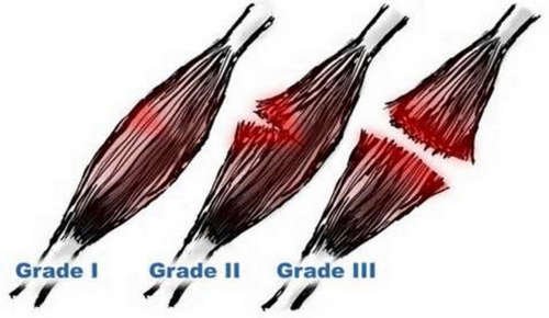 The grading system used for diagnosing intercostal muscle strain image photo picture